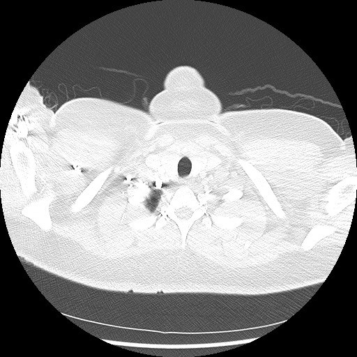 Alveolar soft part sarcoma - right leg (Radiopaedia 59432-67091 Axial lung window 9).jpg