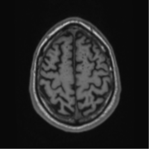 File:Alzheimer's disease- with Gerstmann syndrome and dressing apraxia (Radiopaedia 54882-61150 Axial T1 62).png