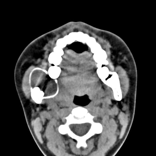 File:Ameloblastoma (Radiopaedia 26645-26793 Axial C+ delayed 20).jpg