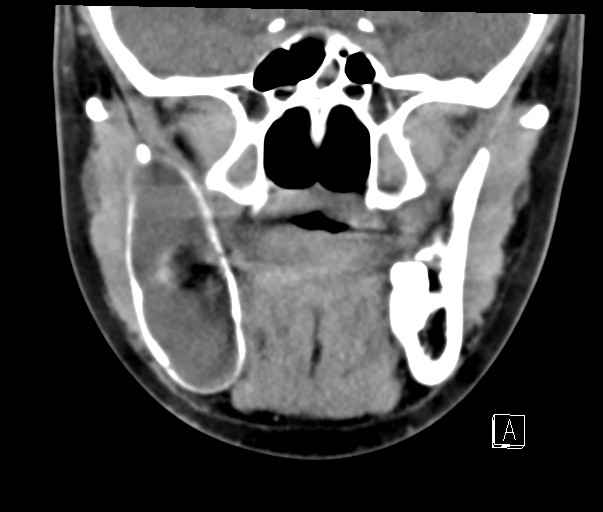 File:Ameloblastoma (Radiopaedia 26645-26793 Coronal C+ delayed 6).jpg