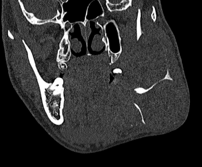 Ameloblastoma (Radiopaedia 51921-57766 Coronal bone window 113).jpg