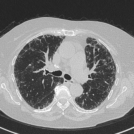Amiodarone-induced pulmonary fibrosis (Radiopaedia 82355-96460 Axial lung window 29).jpg