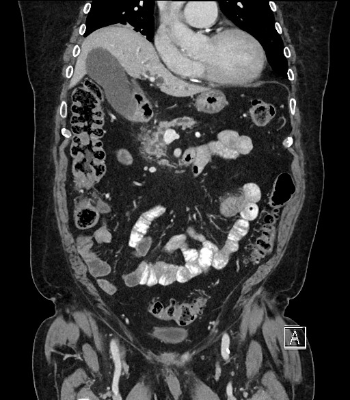 Ampullary adenocarcinoma (Radiopaedia 59373-66734 D 35).jpg