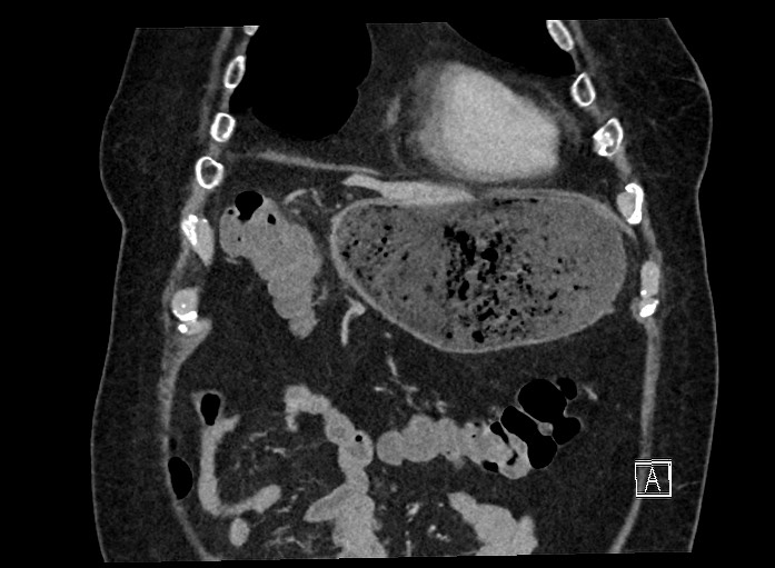 Ampullary adenocarcinoma (Radiopaedia 59373-66737 B 18).jpg