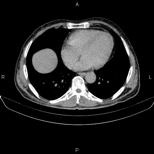 Ampullary adenocarcinoma (Radiopaedia 86093-102032 Axial C+ delayed 3).jpg