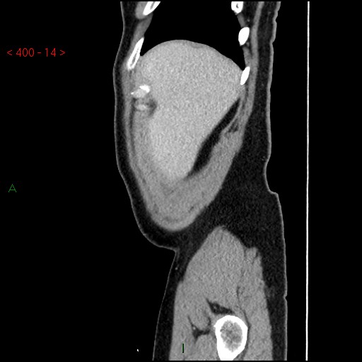 Ampullary carcinoma (Radiopaedia 56396-63056 D 13).jpg