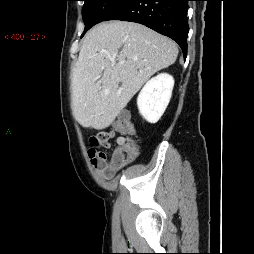 Ampullary carcinoma (Radiopaedia 56396-63056 D 26).jpg