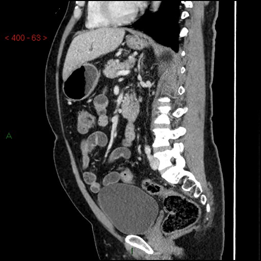 Ampullary carcinoma (Radiopaedia 56396-63056 D 62).jpg
