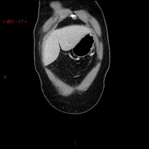 Ampullary carcinoma (Radiopaedia 56396-63056 E 16).jpg