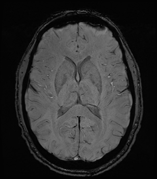 Amyotrophic lateral sclerosis (Radiopaedia 87352-103658 Axial SWI 31).jpg