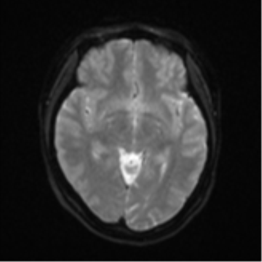 Anaplastic astroblastoma (Radiopaedia 55666-62194 Axial DWI 13).png