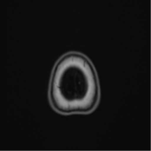 Anaplastic astroblastoma (Radiopaedia 55666-62194 Axial T1 73).png