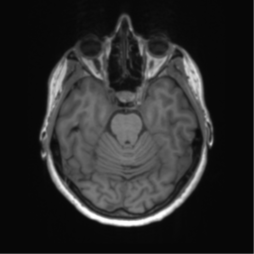 File:Anaplastic astrocytoma - thalamic glioma (Radiopaedia 59709-67115 Axial T1 2).png
