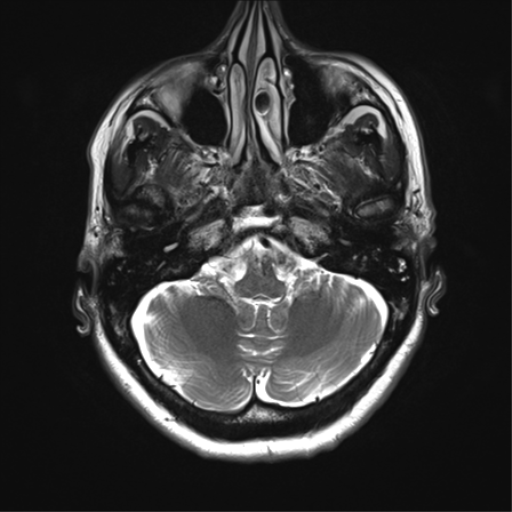 File:Anaplastic astrocytoma - thalamic glioma (Radiopaedia 59709-67115 Axial T2 8).png