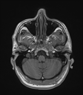 Anaplastic astrocytoma IDH wild-type (Radiopaedia 49984-55273 Axial T1 12).png