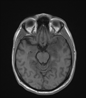 Anaplastic astrocytoma IDH wild-type (Radiopaedia 49984-55273 Axial T1 23).png