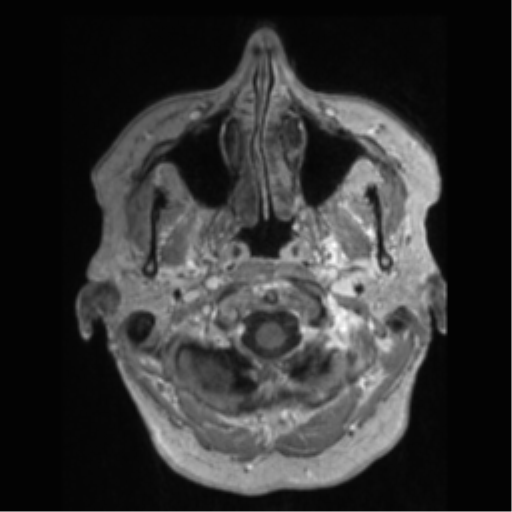 Anaplastic astrocytoma IDH wild-type (pseudoprogression) (Radiopaedia 42209-45277 Axial T1 C+ 2).png