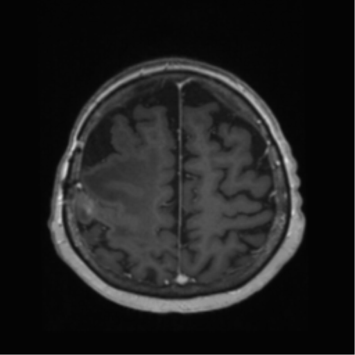 File:Anaplastic astrocytoma IDH wild-type (pseudoprogression) (Radiopaedia 42209-45278 Axial T1 C+ 118).png