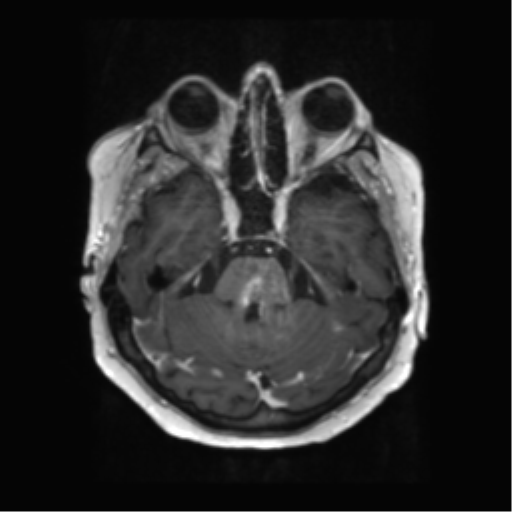 File:Anaplastic astrocytoma IDH wild-type (pseudoprogression) (Radiopaedia 42209-45279 Axial T1 C+ 46).png