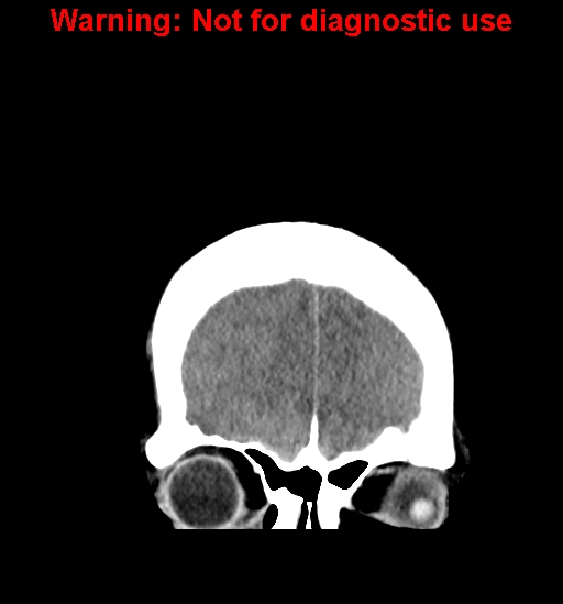 File:Anaplastic ganglioglioma (Radiopaedia 44921-48815 Coronal non-contrast 6).jpg
