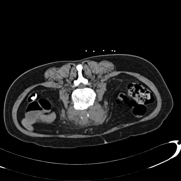 File:Anaplastic lymphoma - with CT biopsy (Radiopaedia 21643-21602 Axial non-contrast 48).jpg