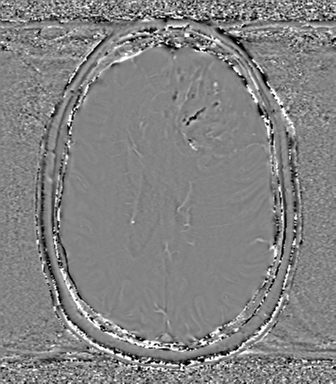 Anaplastic oligodendroglioma (Radiopaedia 83500-98599 Axial SWI - phase 53).png