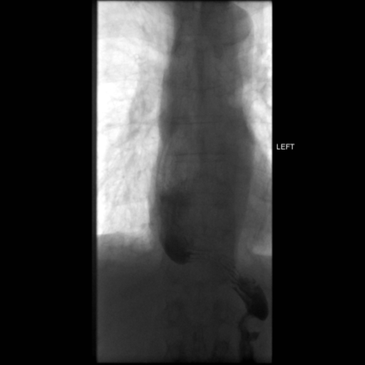 File:Anastomotic stricture post Ivor Lewis esophagectomy (Radiopaedia 47937-52715 C 14).png