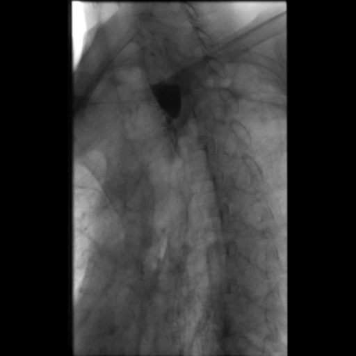 File:Anastomotic stricture post Ivor Lewis esophagectomy (Radiopaedia 47937-52715 Oblique 11).png
