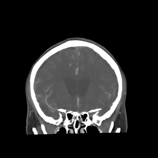 Aneursym related subarachnoid hemorrhage with hydrocephalus (Radiopaedia 45105-49084 B 27).jpg