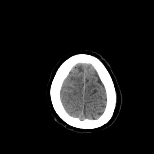 Aneursym related subarachnoid hemorrhage with hydrocephalus (Radiopaedia 45105-49085 Axial non-contrast 46).jpg