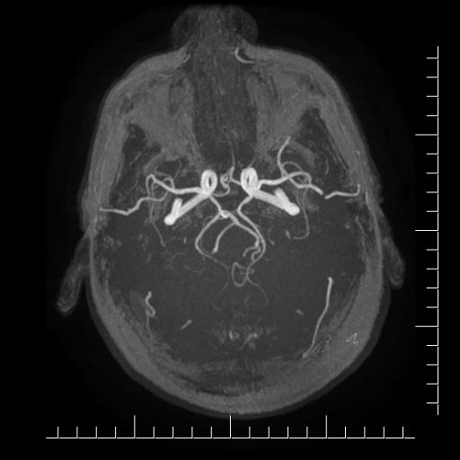 File:Aneurysm of posterior communicating artery (Radiopaedia 20188-20163 MRA 1).jpg