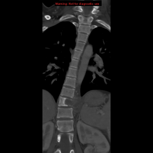 File:Aneurysmal bone cyst (Radiopaedia 9419-10102 Coronal bone window 7).jpg