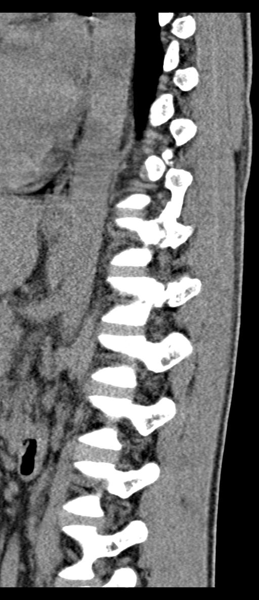 Aneurysmal bone cyst T11 (Radiopaedia 29294-29721 E 27).jpg