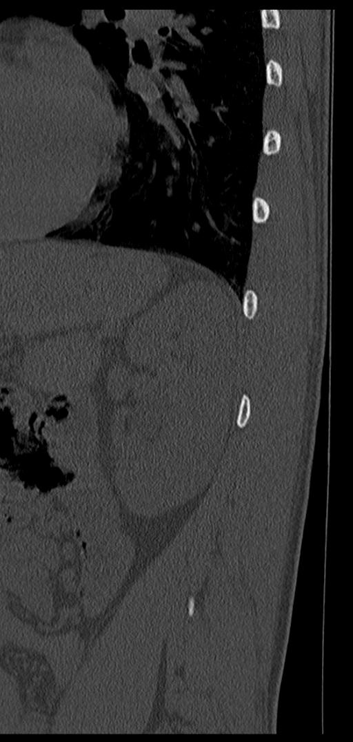 Aneurysmal bone cyst T11 (Radiopaedia 29294-29721 Sagittal bone window 5).jpg