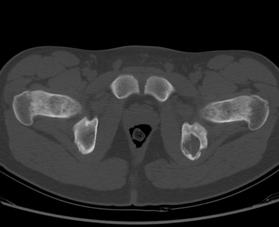 File:Aneurysmal bone cyst of ischium (Radiopaedia 25957-26094 Axial bone window 66).png