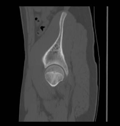 Aneurysmal bone cyst of ischium (Radiopaedia 25957-26094 Sagittal bone window 58).png