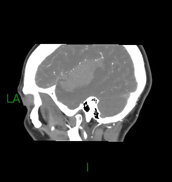 Aneurysmal subarachnoid hemorrhage with intra-axial extension (Radiopaedia 84371-99732 B 56).jpg
