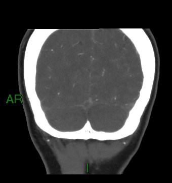 File:Aneurysmal subarachnoid hemorrhage with intra-axial extension (Radiopaedia 84371-99732 C 19).jpg