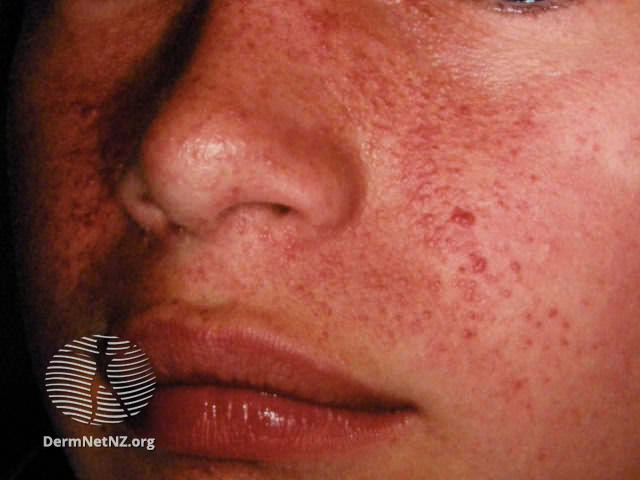 File:Angiofibromas in tuberous sclerosis (DermNet NZ systemic-angiofibromas-19).jpg