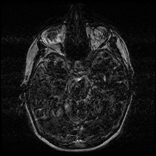 Angioinvasive aspergillosis in the pituitary fossa (Radiopaedia 39676-42010 Ax 3D FIESTA VOLUME 54).png