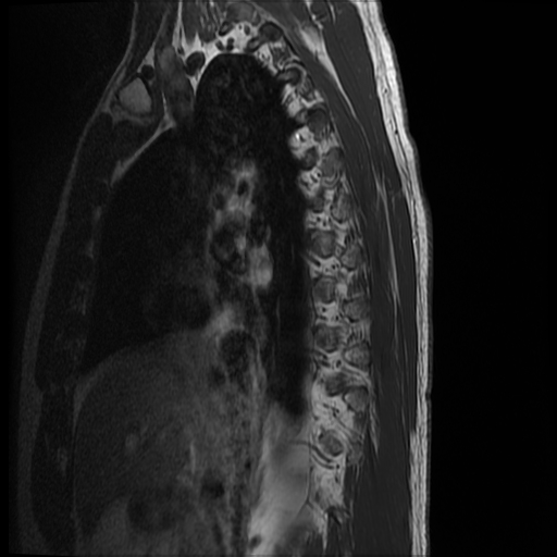 File:Angiolipoma - thoracic spine (Radiopaedia 28242-28479 Sagittal T1 14).jpg