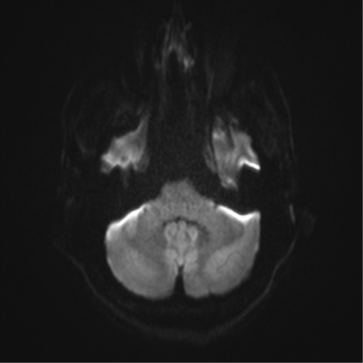 Angular epidermoid cyst (Radiopaedia 46908-51438 Axial DWI 71).png