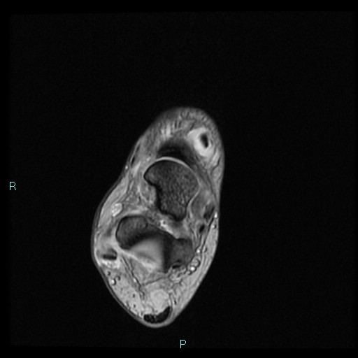 Ankle ganglion cyst (Radiopaedia 62809-71162 Axial Gradient Echo 46).jpg
