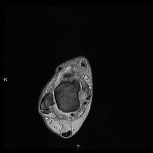 Ankle ganglion cyst (Radiopaedia 62809-71162 Axial Gradient Echo 57).jpg