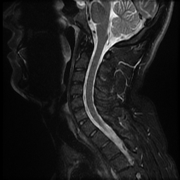 File:Ankylosing spondylitis - shiny corner sign (Radiopaedia 52084-57939 Sagittal T2 16).jpg