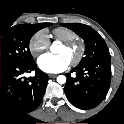 File:Anomalous left coronary artery from the pulmonary artery (ALCAPA) (Radiopaedia 70148-80181 A 166).jpg
