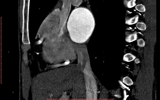 File:Anomalous left coronary artery from the pulmonary artery (ALCAPA) (Radiopaedia 70148-80181 C 60).jpg