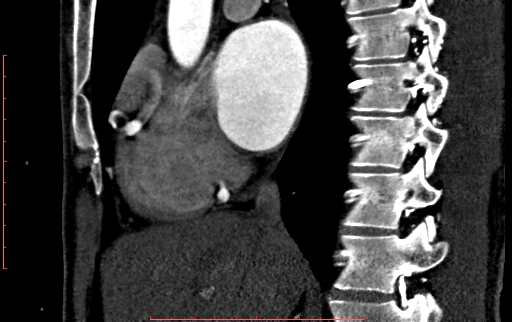 File:Anomalous left coronary artery from the pulmonary artery (ALCAPA) (Radiopaedia 70148-80181 C 77).jpg