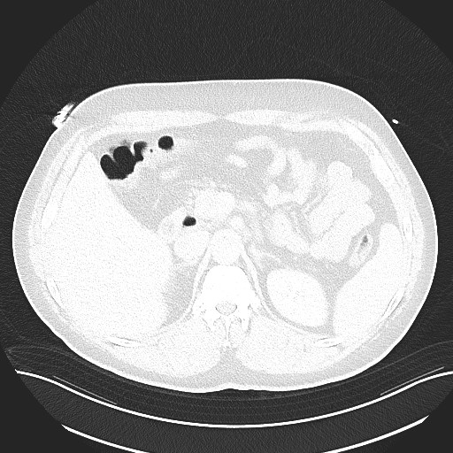 File:Anomalous origin of the left coronary artery with malignant course (Radiopaedia 77842-90126 Axial lung window 38).jpeg
