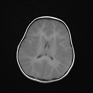 File:Anoxic brain injury (Radiopaedia 79165-92139 Axial T1 17).jpg